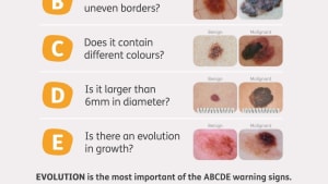 MELANOMA - CHECK FOR THE SIGNS